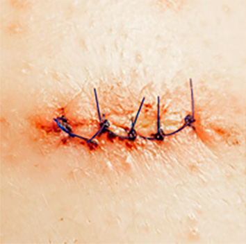 suturas
